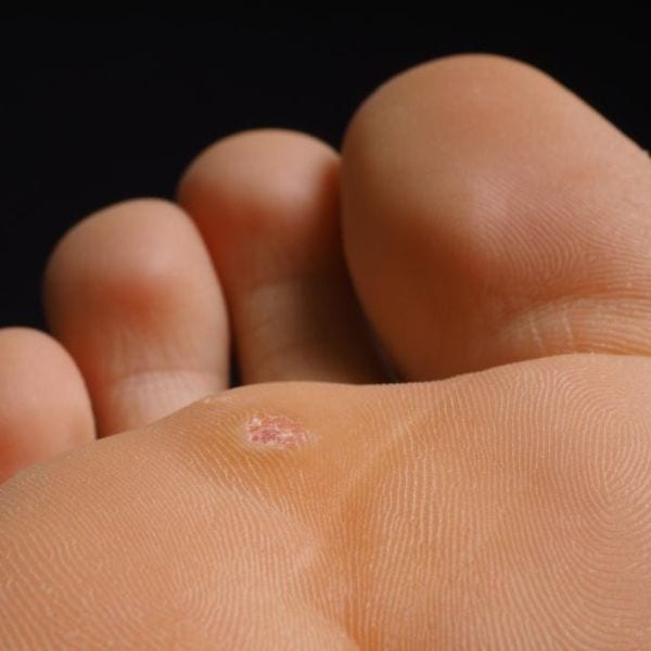 Warts And Verrucas Causes And Solutions Simply Clinics 