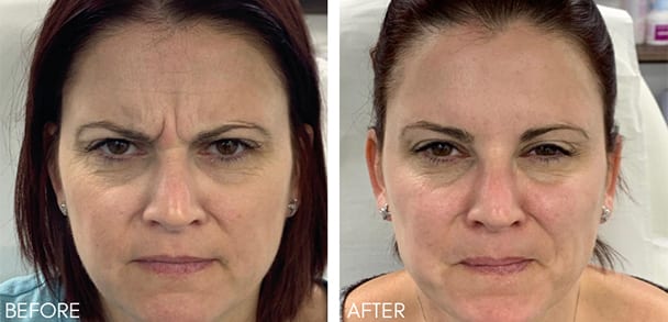 Anti Wrinkle Injections London