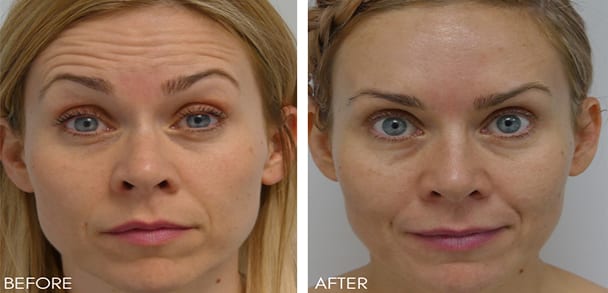 Anti Wrinkle Injections London