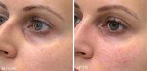 tear trough filler, tear trough before and after