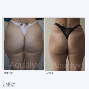 aqualyx_before_and_after