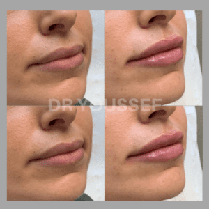 before & after lip fillers witih Dr Youssef