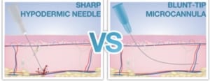 Cannula_vs_needle_lip_filler