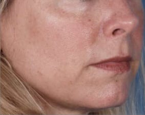 ZO_Skin_Health_Ageing_Before