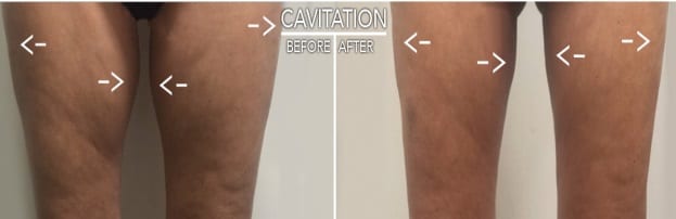 Cavitation, Greater London