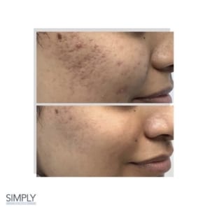 chemical_peel_pigmentation_before_and_after