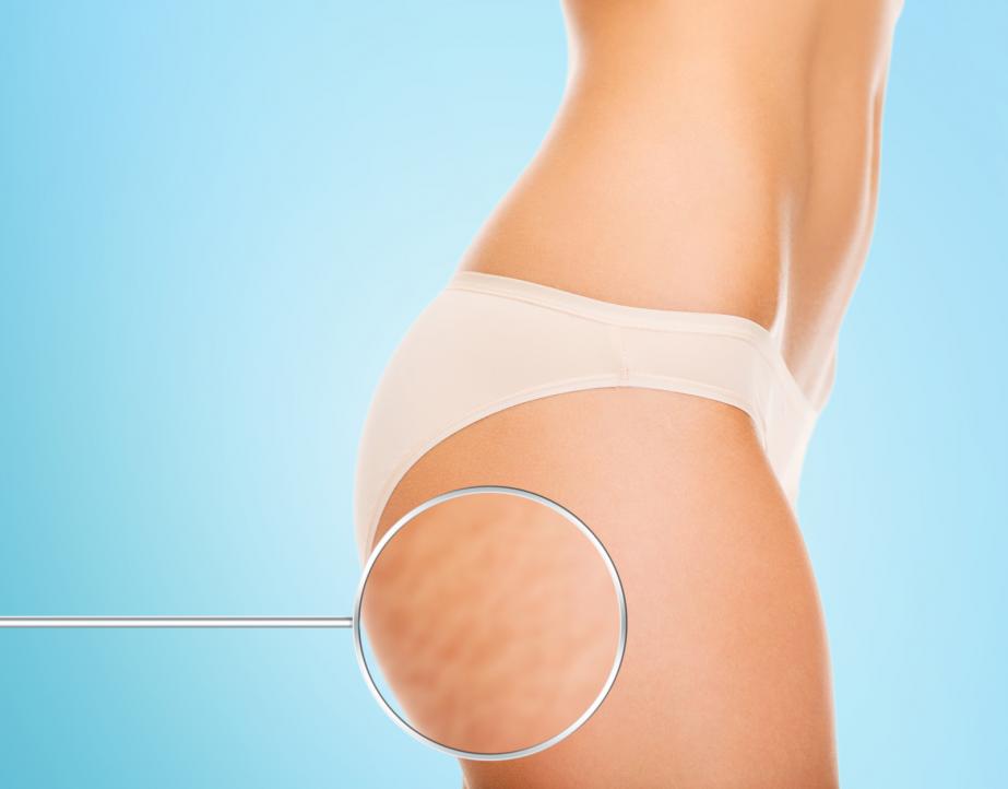 Cellulite Treatment Chelsea