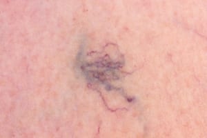 spider veins on the skin