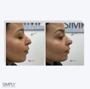 facial_balancing_profile_before_and_after