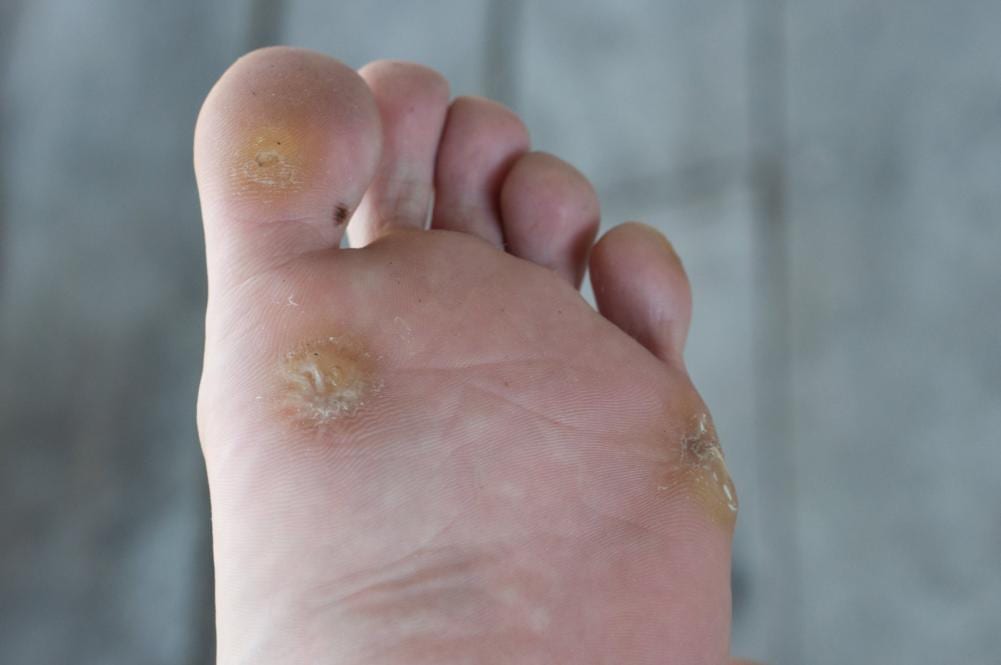 foot showing 3 warts