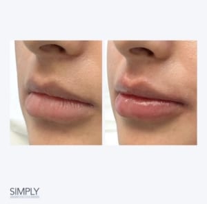 lip fillers london