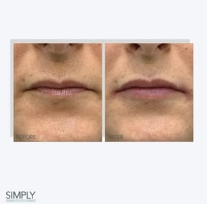 lip__dermal_filler_anti_ageing