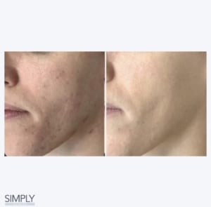 microneedling_acne_results