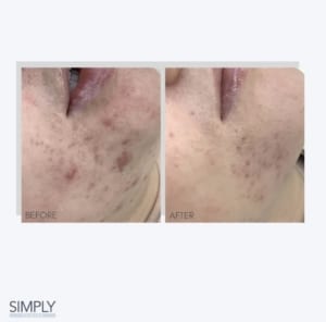 microneedling_acne_results