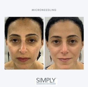 microneedling_pigmentatino_before_and_after