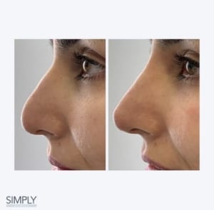 non-surgical_nose_job