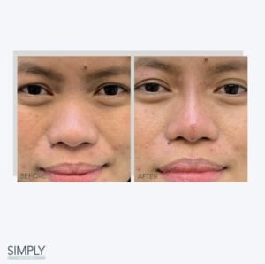 non_surgical_rhinoplasty