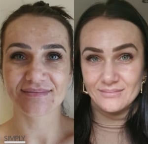 obagi_nu_derm_before_and_after