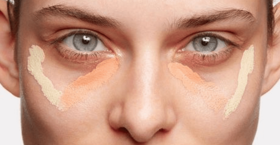 tear_trough_dark_circles_2