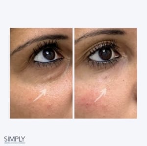 tear_trough_filler_dermal_filler_anti_ageing