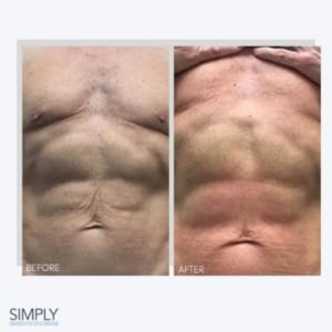 body_tweakments_3d_lipo_stomach