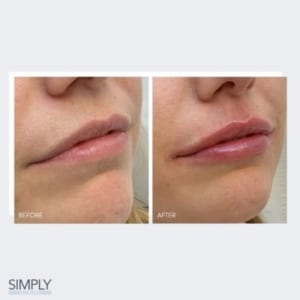 natural filler, natural dermal filler, natural aesthetics, natural lip filler