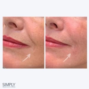 natural filler, natural dermal filler, natural aesthetics