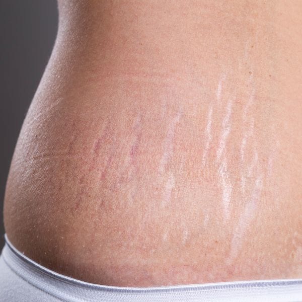 How To Get Rid Of Stretch Marks Simply Clinics 1214