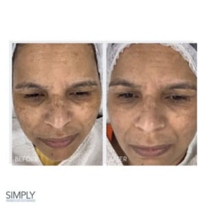 microneedling_for_pigmentation