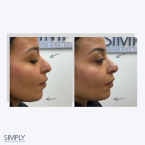 double_chin_dermal_filler_before_after