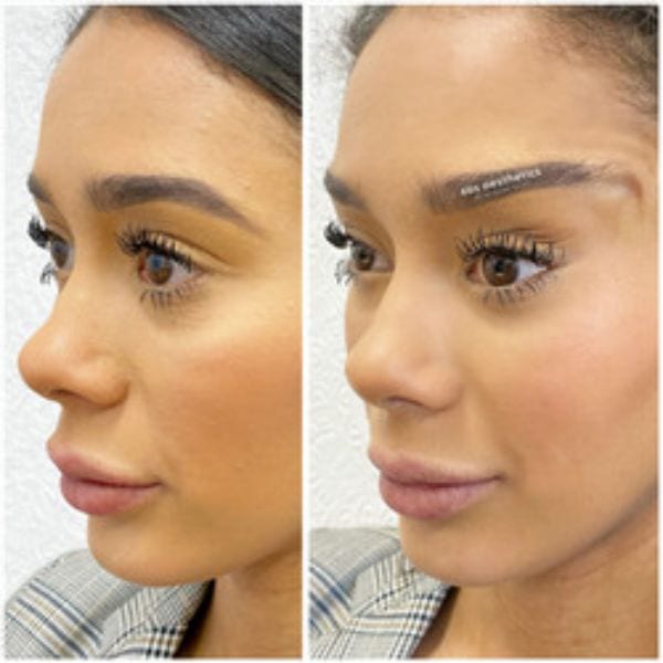 What Are PDO Threads? Simply Clinics