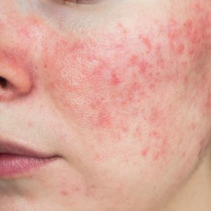 rosacea_signs_