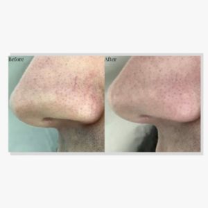 rosacea_thermavein_