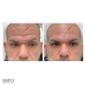 mens_tweakments_forehead_filler_