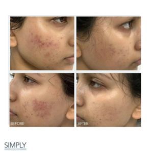 skin_device_microneedling_