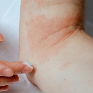 sensitive_skin_eczema_-300x300.jpg