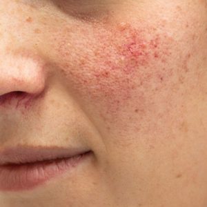 sensitive_skin_rosacea_-300x300.jpg