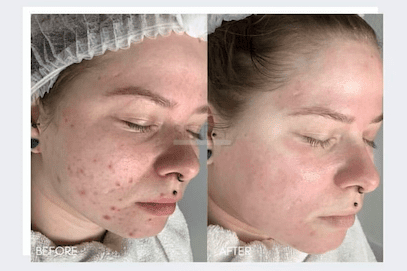 microneedling before and after