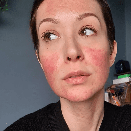 rosacea skin