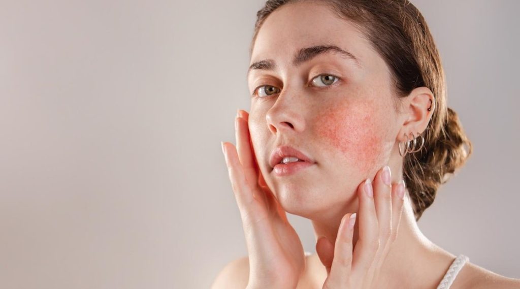 How to manage rosacea