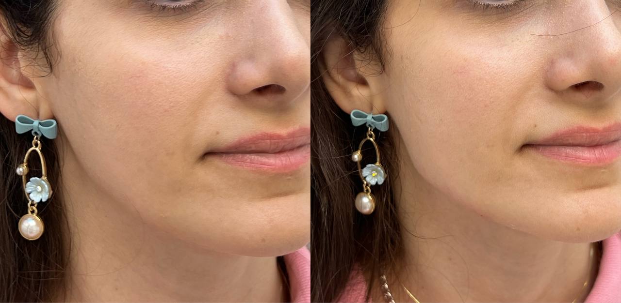 dermal filler - jawline