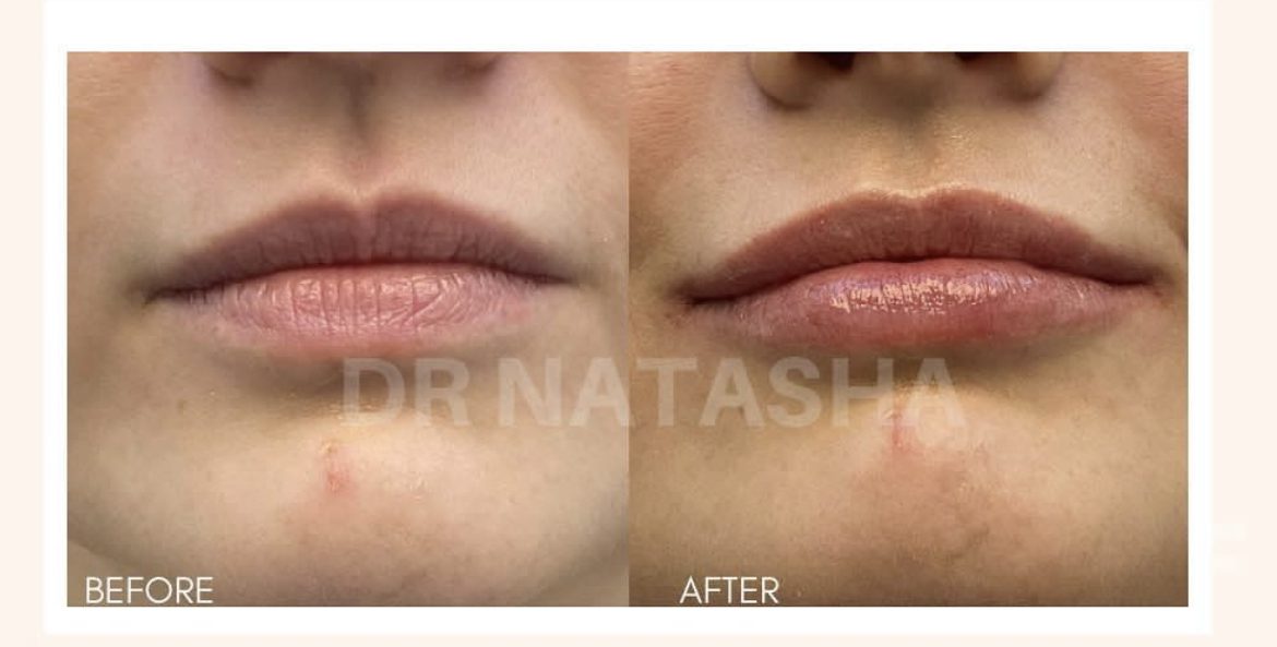 lasting lip filler