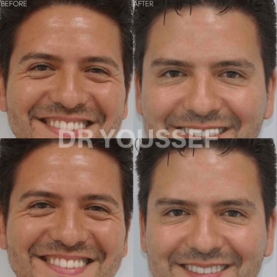 anti-wrinkle injections men treatment