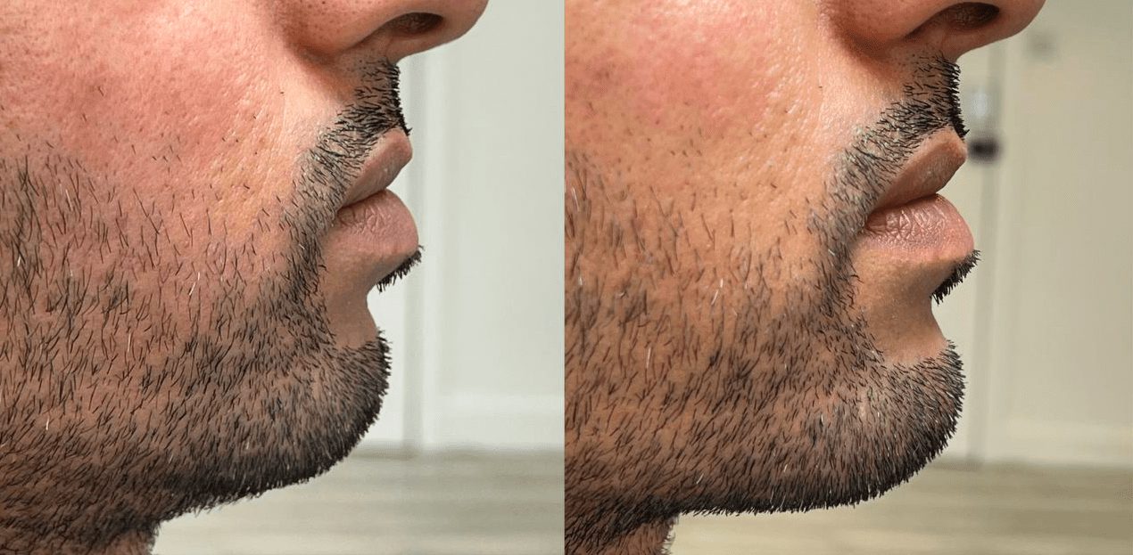 The Rise of Jawline Fillers for Men - The Cosmetic Skin Clinic