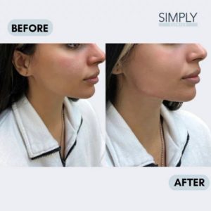 Jawline filler before and after 