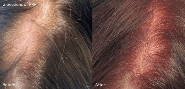 PRP treatment before and after