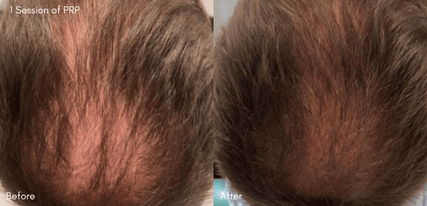 PRP treatment before and after