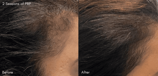 PRP treatment before and after