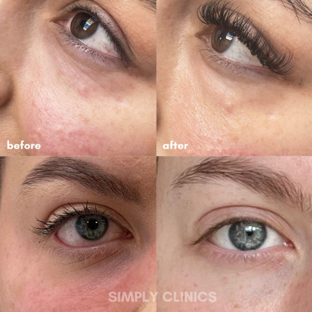 LUMI EYES TREATMENT