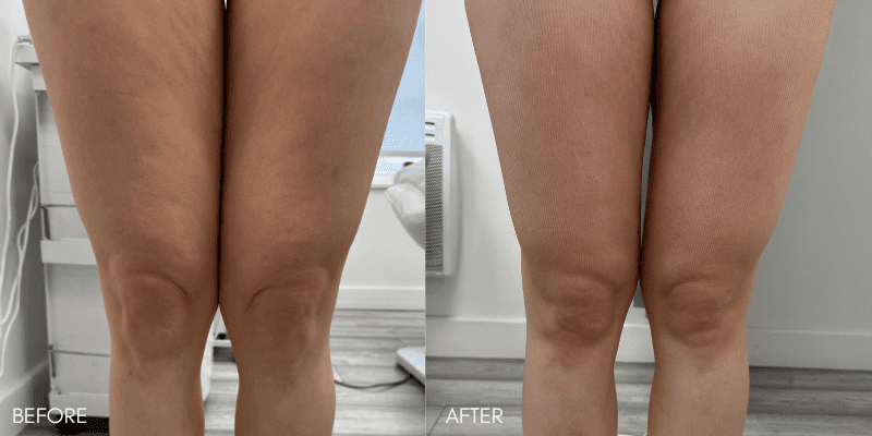 lpg endermologie before after simply clinics